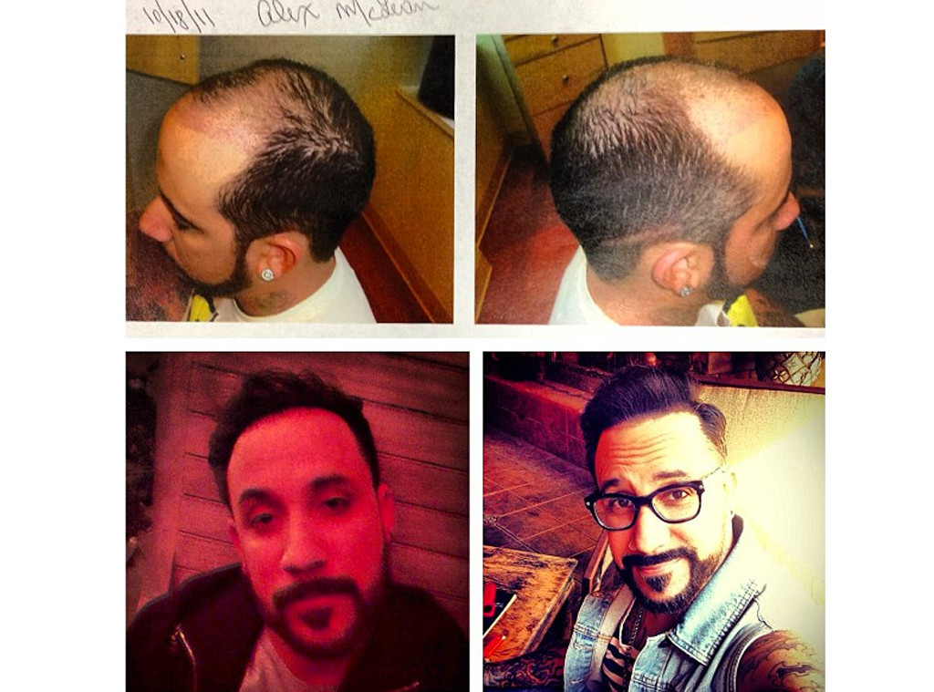 A J Mclean Reveals Hair Transplant E Online